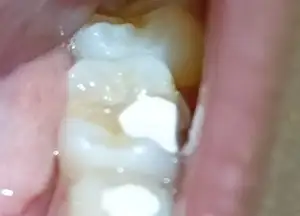 দাঁতের গর্ত কেন হয়